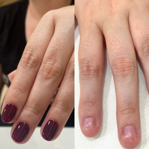 Soluciones para uñas con onicofagia en la V Región y Santiago: Tratamientos efectivos en BellaPiel